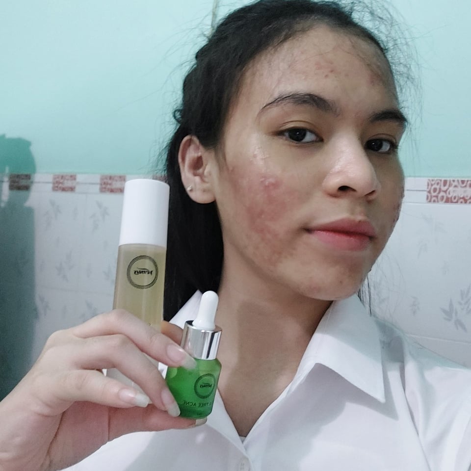 [HCM]Combo Sạch Mụn Thâm Trắng Da Venus