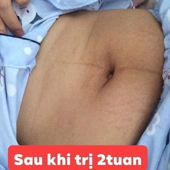 Kem xóa\làm mờ rạn da\thâm da Multi 16