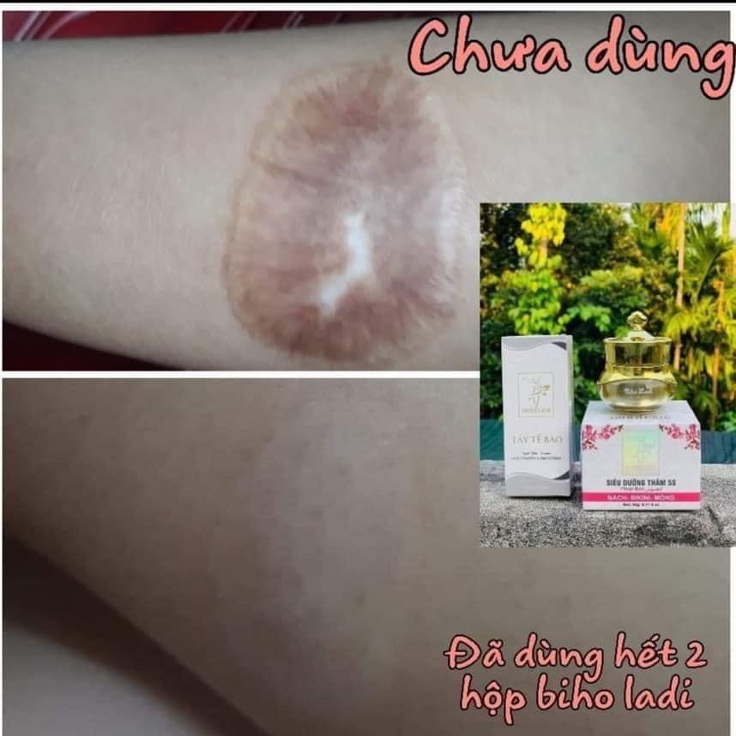 BIHO LADI SIÊU DƯỠNG THÂM 5S, [COMBO 2 HỘP] GIẢM 80K (TẶNG KÈM QUÀ)