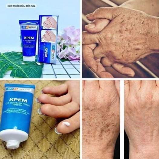 [HCM]Kem Tri Đồi Mồi Đốm nâu Da Tay Kpem Nga