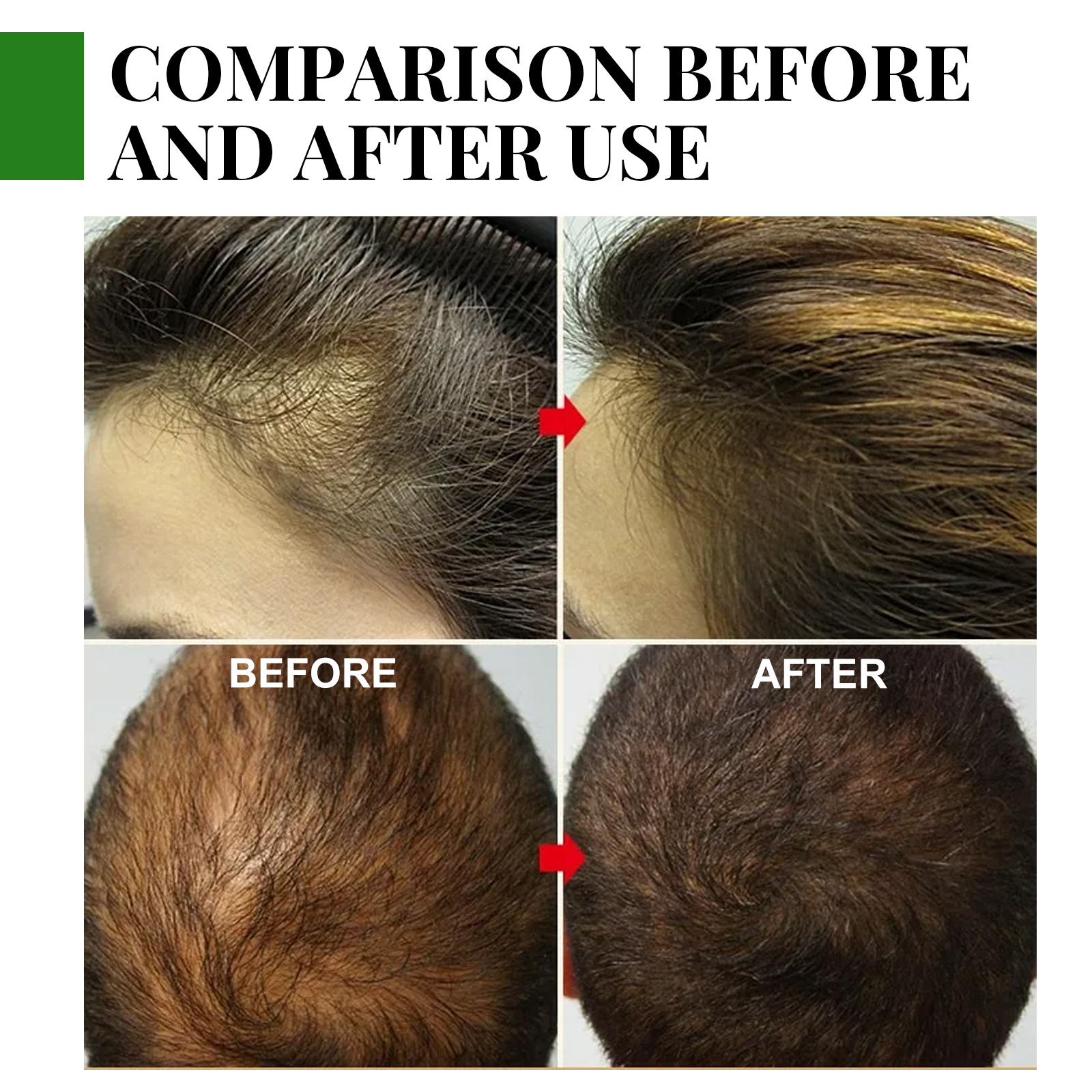 EELHOE Tinh Dầu Xịt Mọc Tóc 30ML Tinh Dầu Dưỡng Tóc Chống Rụng Mọc Tóc