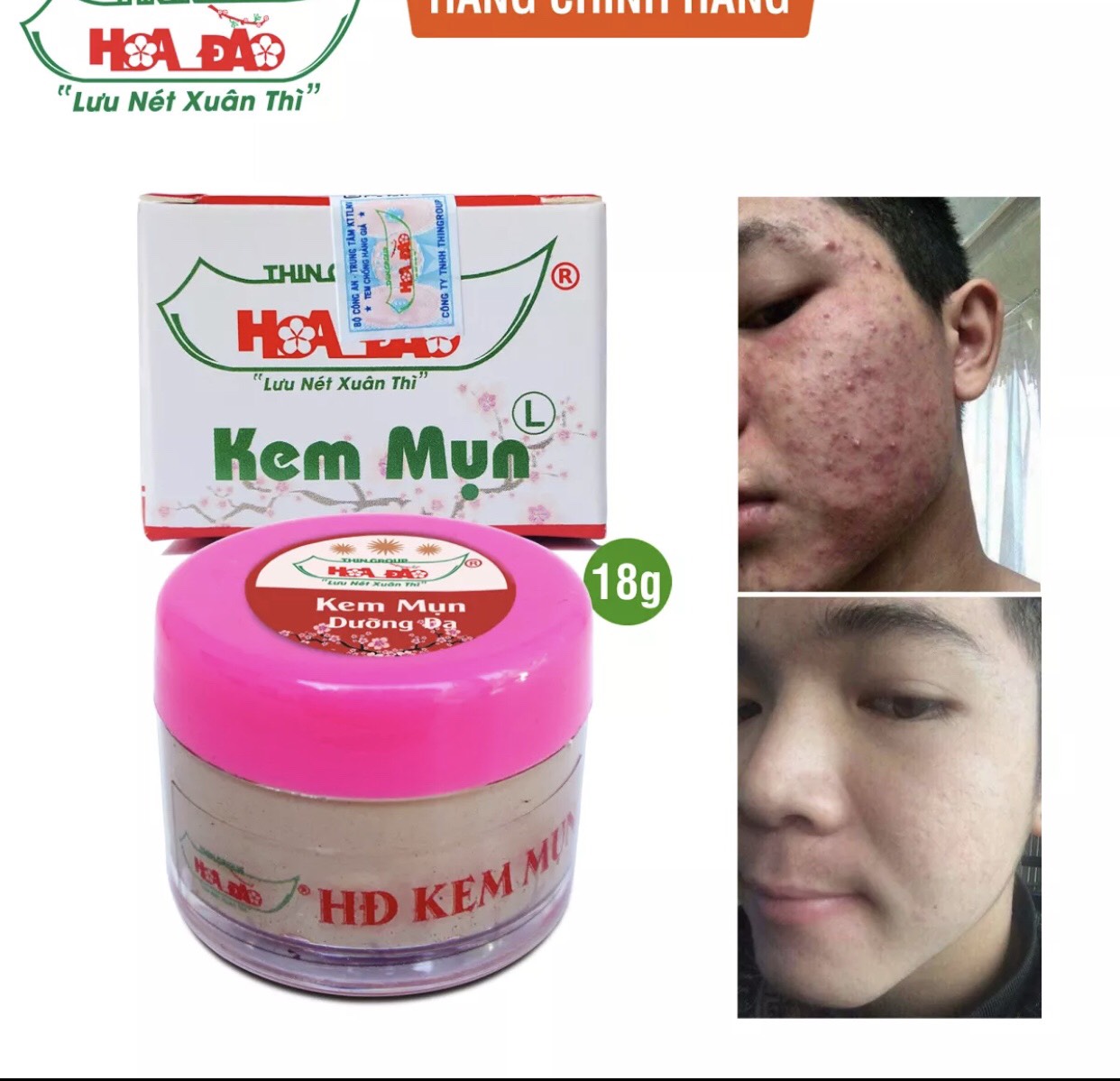 [HCM](GIÁ SỈ) Combo 5 Hộp Kem Mụn Hoa Đào 18 gram