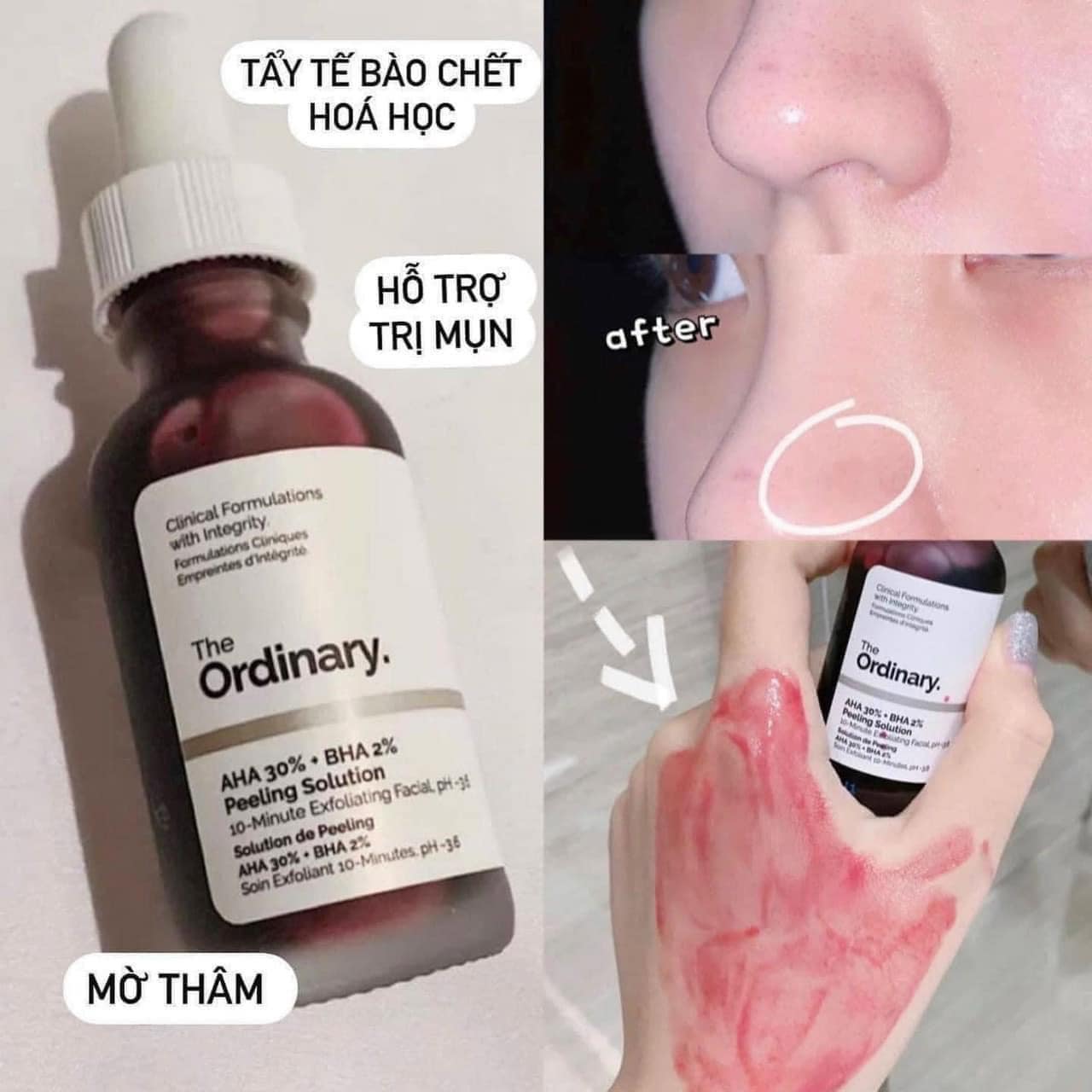 Serum Tẩy Da Chết The Ordinary AHA 30% + BHA 2%