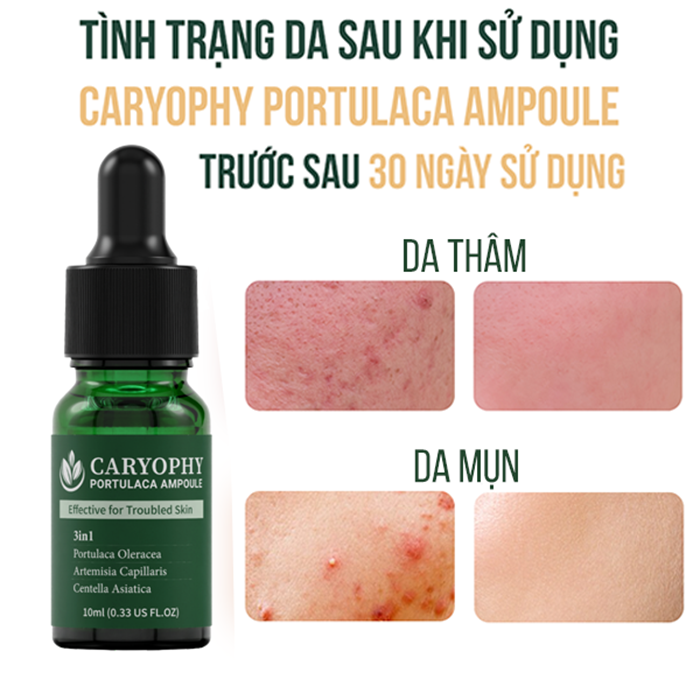 Combo chăm sóc da giảm mụn mờ thâm Caryophy Portulaca (Serum giảm mụn 10ml - Toner không cồn 300ml)