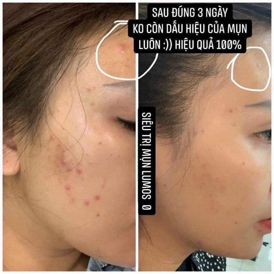 [mẫu mới 2021] Serum Mụn Dưỡng Trắng Da Lumos Acne Cao Cấp