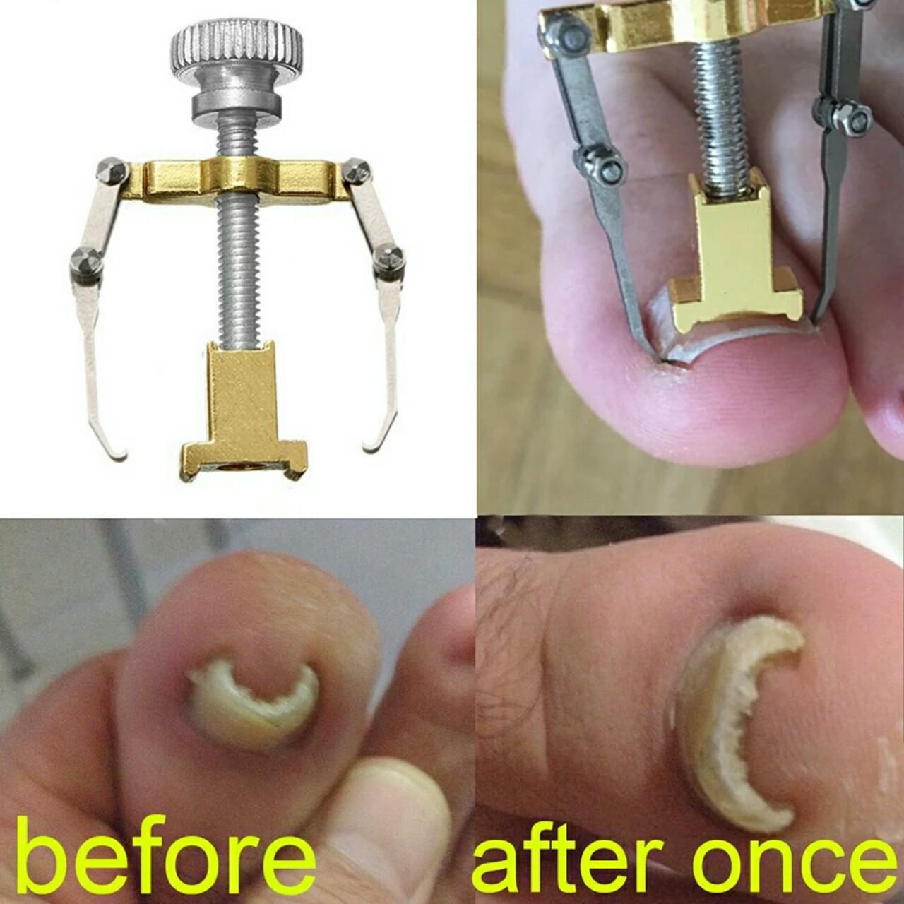 Dụng cụ chữa móng quặp móng chân chọc thịt đau đớn