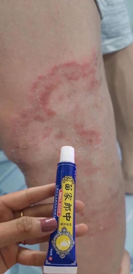 kem bôi nấm, hắc lào, lang ben
