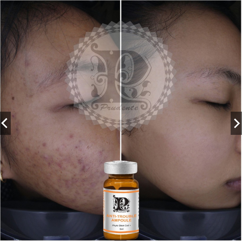 Serum Mụn Anti Trouble Ampoule [ MIBITI ] 5ml/Chai