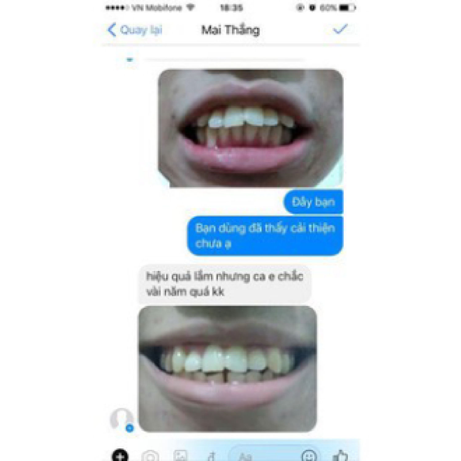 Niềng răng silicon tại nhà, khay niềng răng  silicon