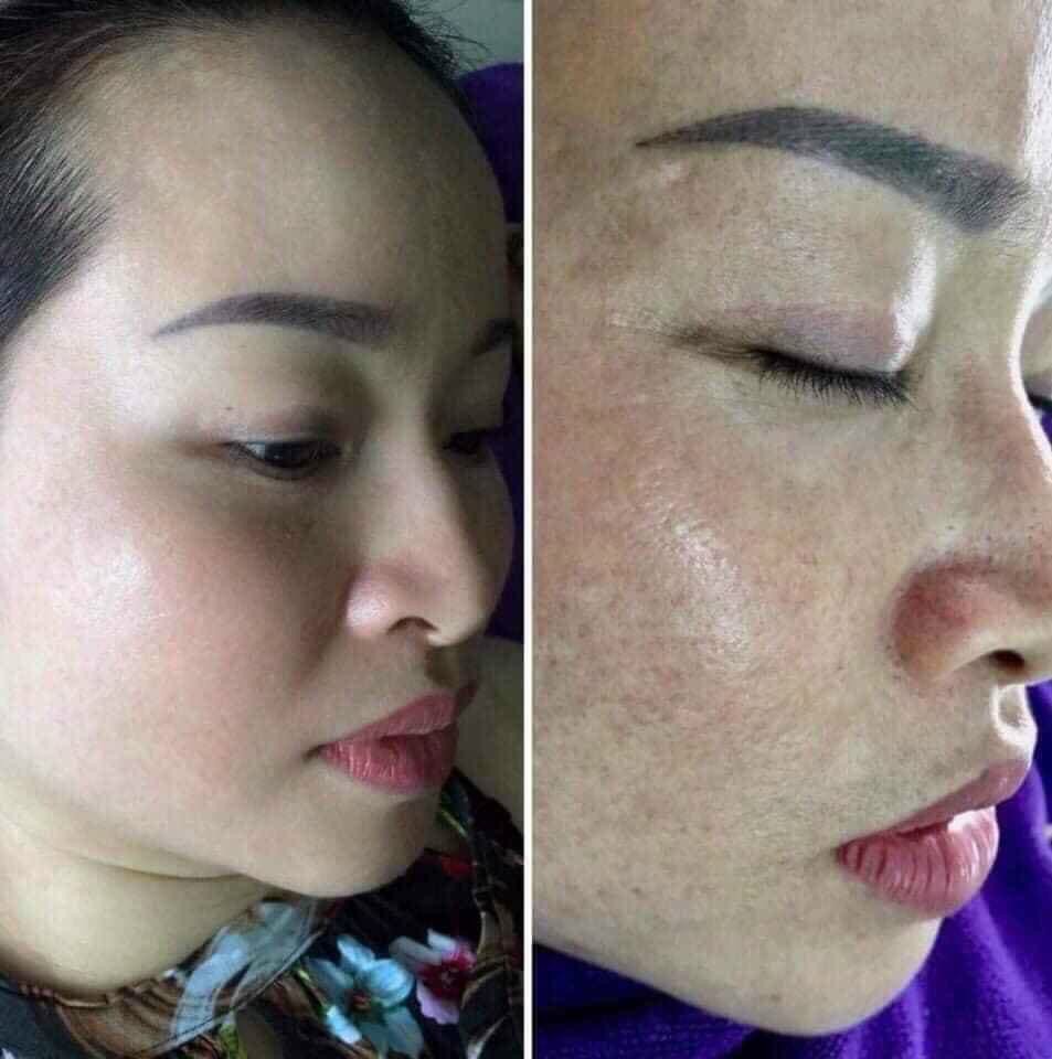 Serum trị mụn Huyết mộc nhan