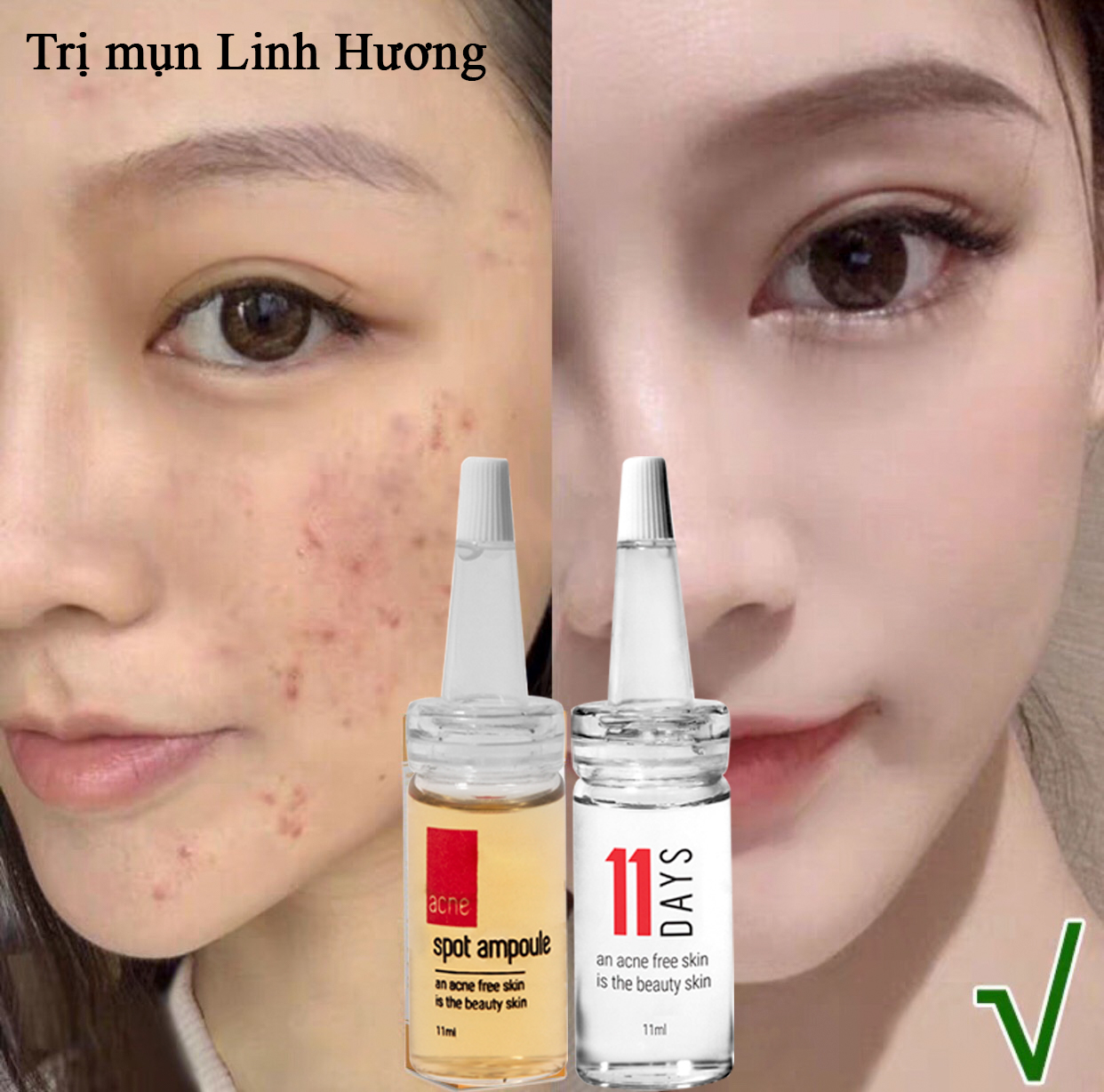 PURITY SKIN TINH CHẤT MỤN LINH HƯƠNG