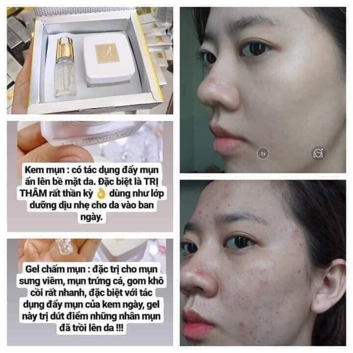 Combo Giảm Mụn Siêu Tốc A Cosmetics Kem dưỡng Acnes giúp dưỡng da thâm se khít lỗ chân lông phù hợp với mọi loại da không gây kích ứng da