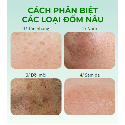 Kem chấm nám - tàn nhan KT