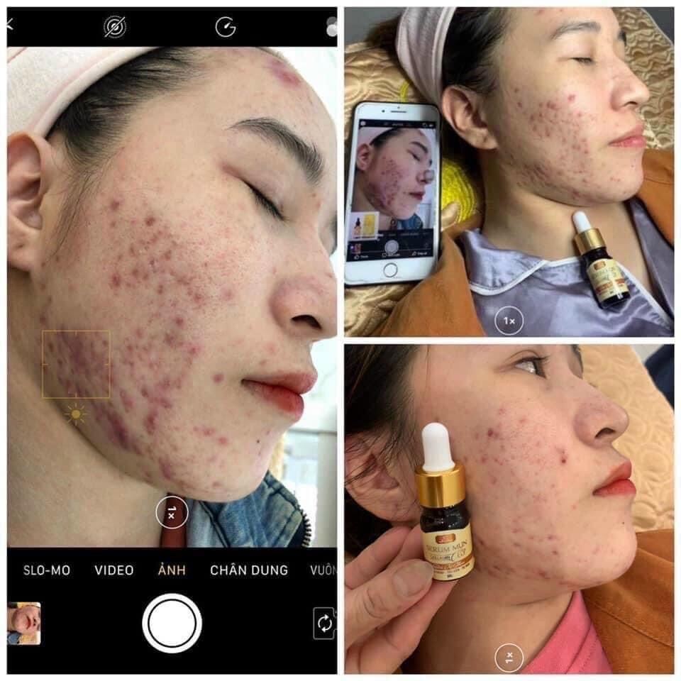 [Chính hãng] Serum mụn Collagen X3 Luxury mỹ phẩm Đông Anh