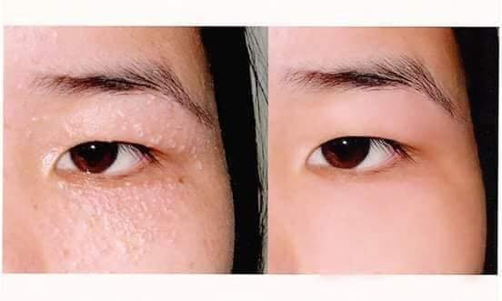 Mụn Thịt Quầng Thâm Nhăn Mẳt