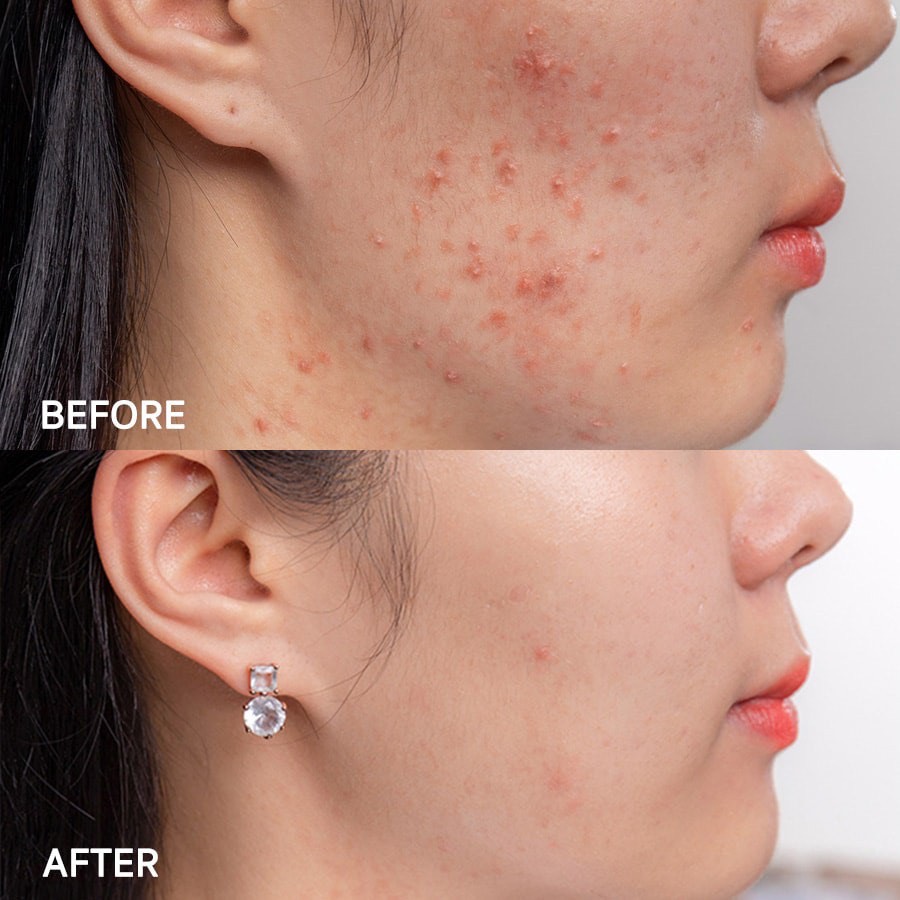 Kem Giảm Mụn Eucerin Pro Acne Solution A.I Clearing Treatment (5/2023)