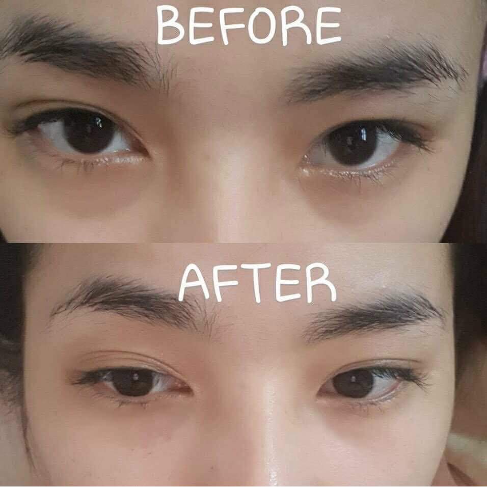 Tan Quầng Thâm Mắt Teoxane 2 - 1 hộp 2cc - Filler Mắt