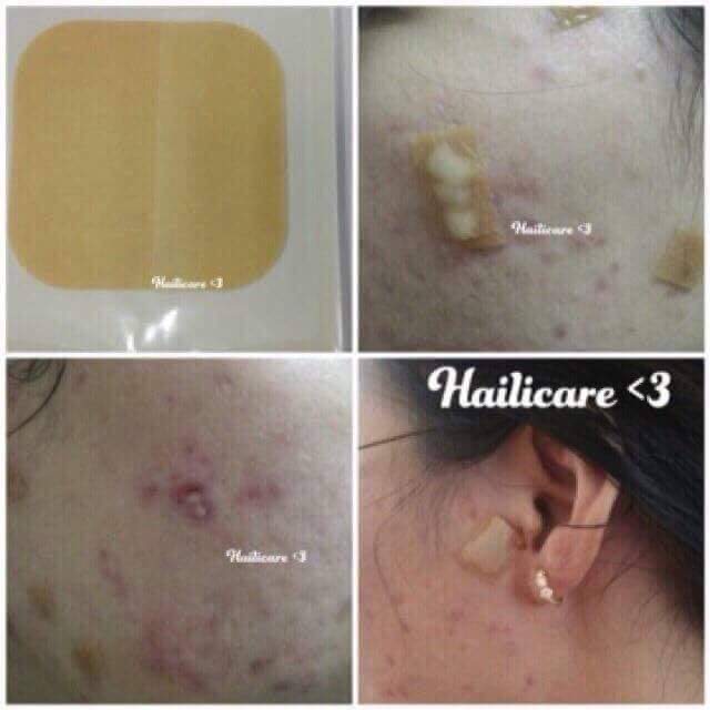 [HCM][Full box 10 miếng] Miếng dán mụn Duoderm Extra Thin (khỏi lo mụn mủ) 10x10