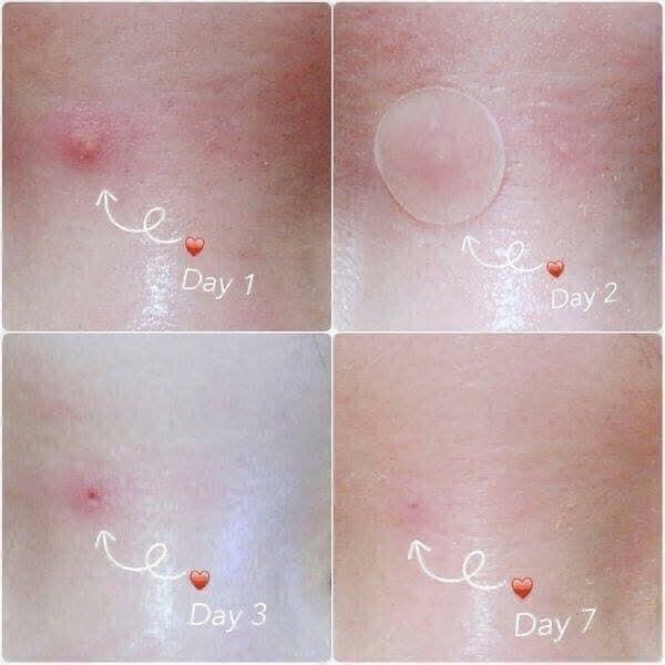 MIẾNG DÁN MỤN CORSX MASTER PATCH ĐEN