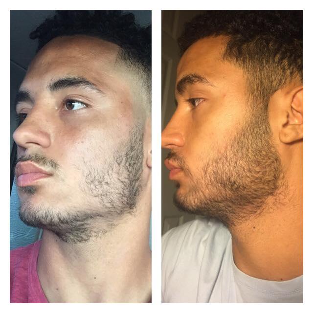 [HCM]Bột Retinol pha Minoxidil