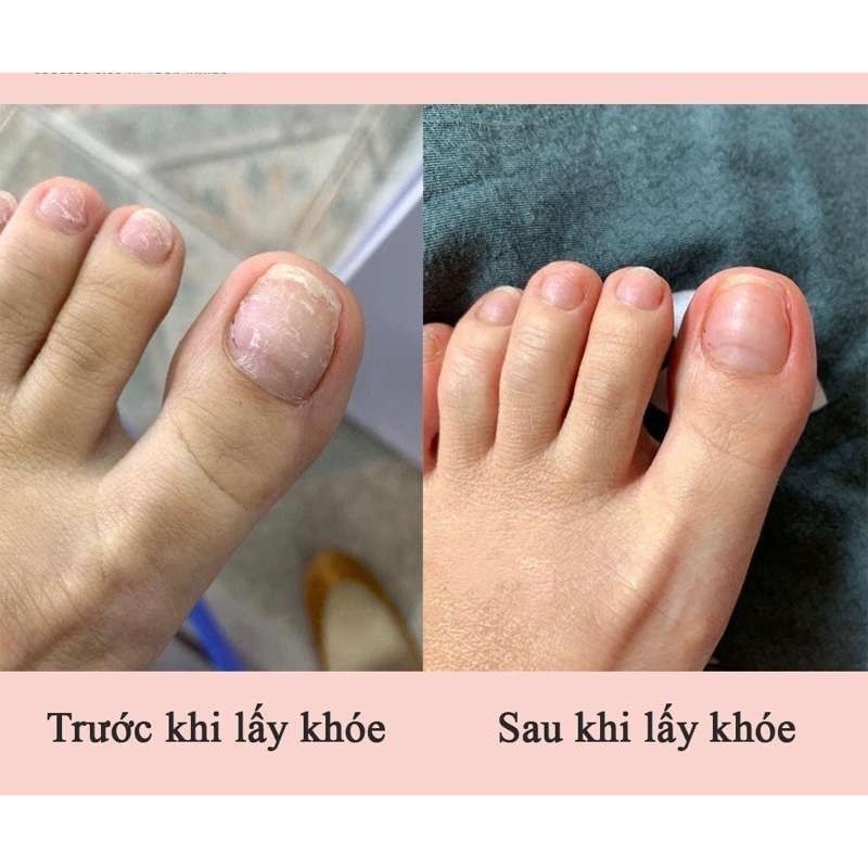 ( Combo 5 cây ) Cây Lấy Khoé Vệ Sinh Móng Tai Móng Chân - Mẫu Cán Gỗ 7cm