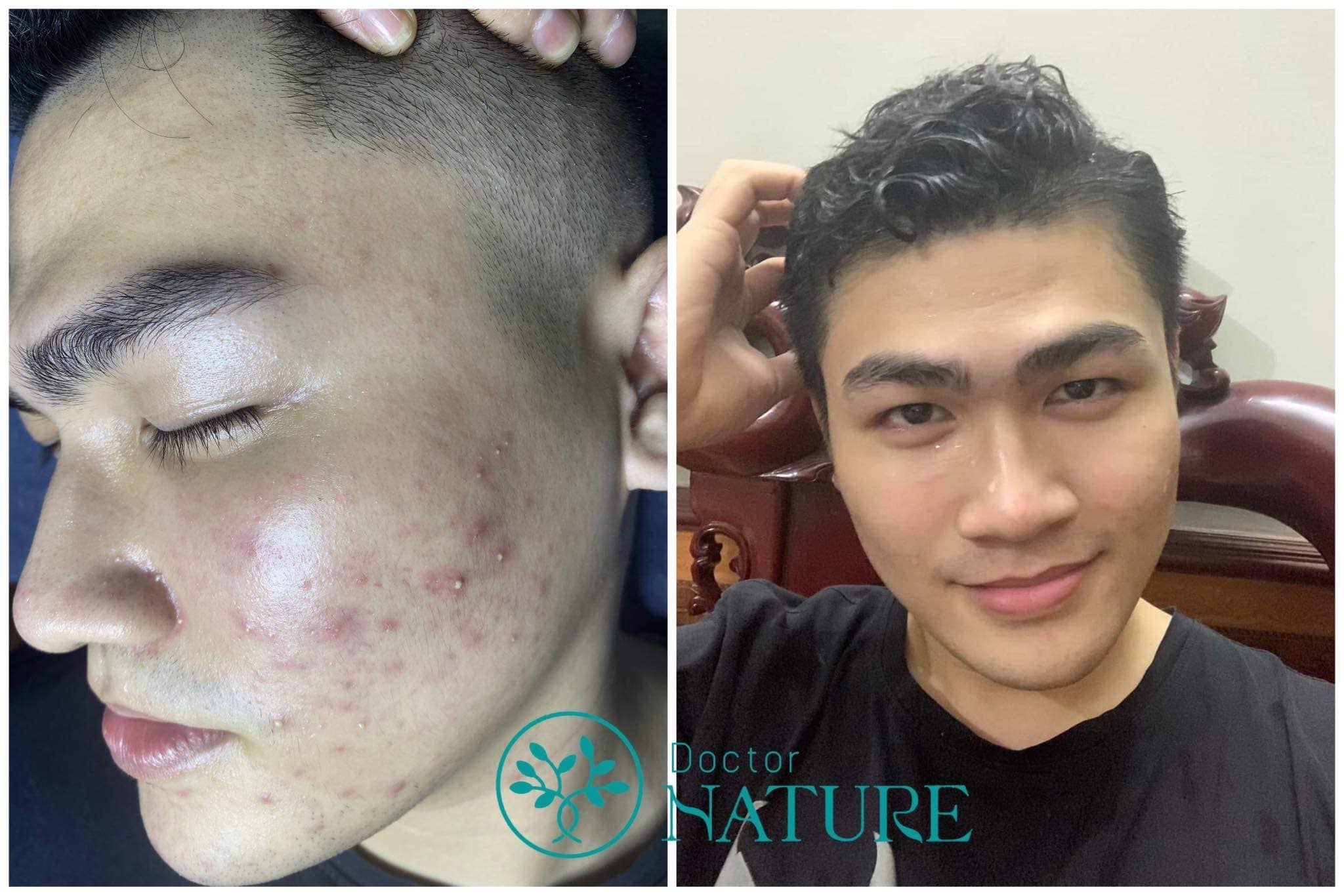 SERUM DETOX MỤN DOCTOR QUEEN -(MAU MOI)