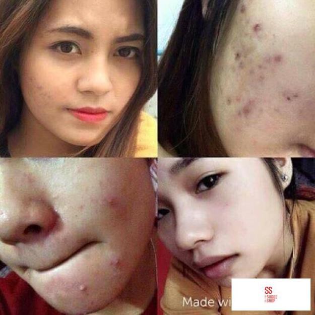 Kem giảm mụn Pair Nhật Bản - kem mụn pair 24g