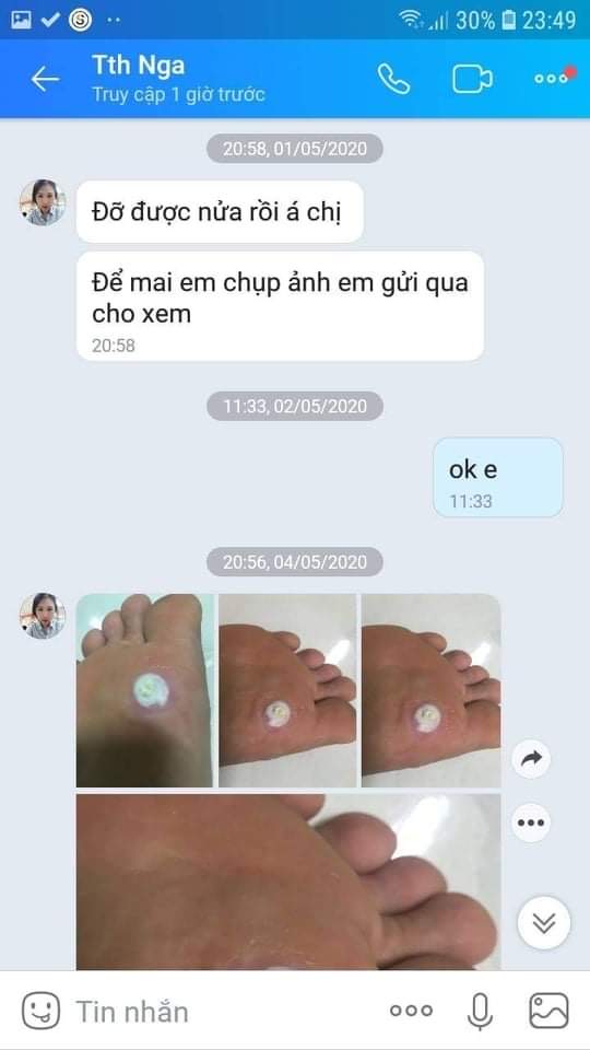 [CHÍNH HÃNG] Miếng dán Ibokorori xoá mụn cơm mụn cóc mắt cá chân Nhật Bản