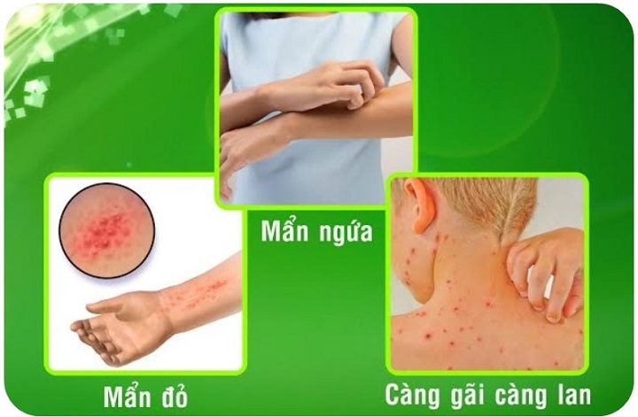 TIÊU BAN THỦY (SIRO TIÊU BAN THỦY) – HỖ TRỢ DỊ ỨNG