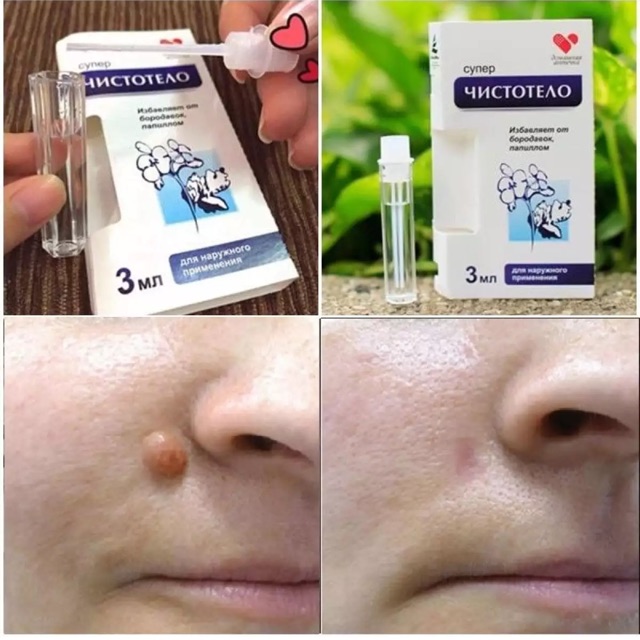 [HCM]Gel tẩy nốt ruồi mụn cóc