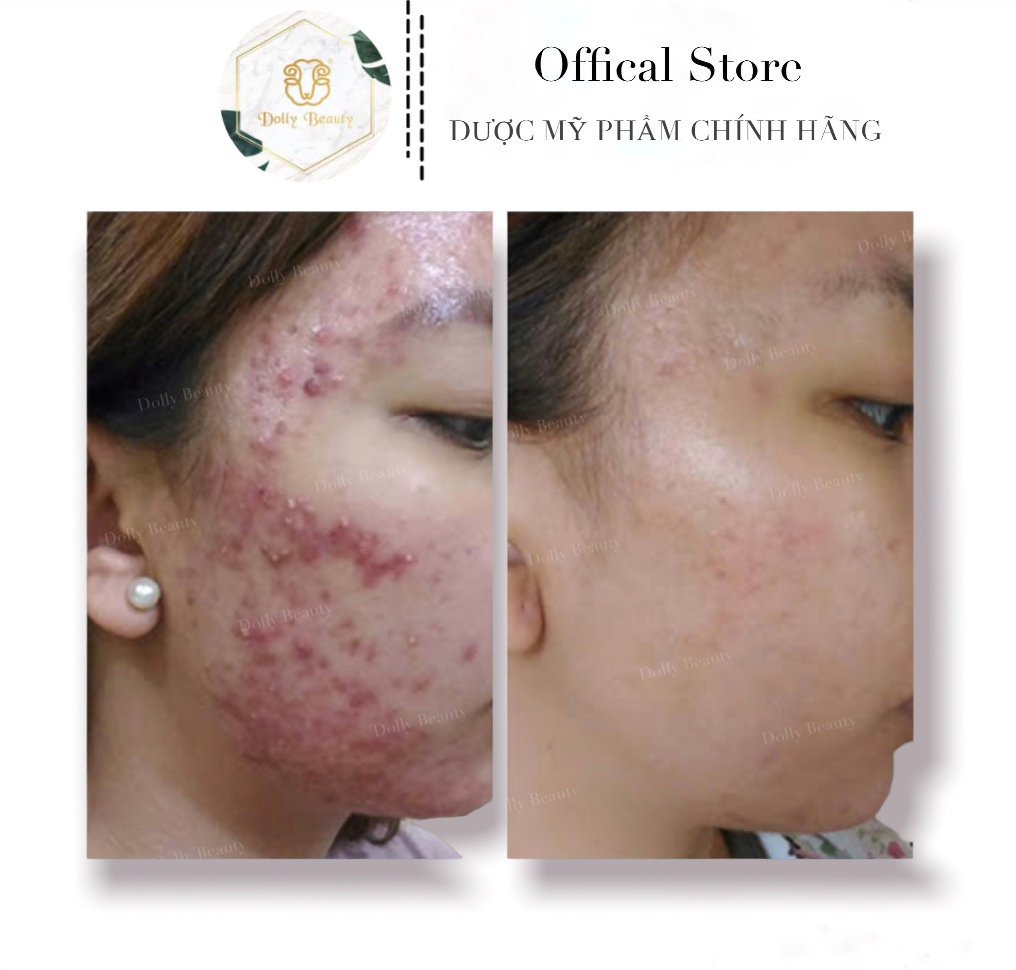 Sữa Rửa Mặt trị mụn REVSKIN DEEP CLEANSER - Dolly Beauty