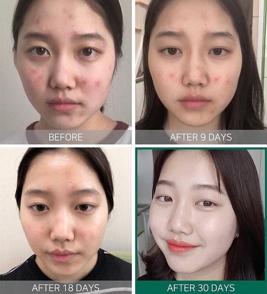 Serum Some By Mi AHA-BHA-PHA Miracle 30 Days 50ml