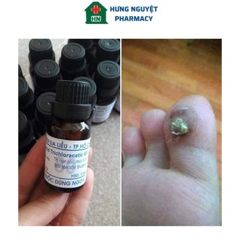 Lọ chấm mụn cơm, mụn cóc, mụn thịt, chai chân Acid Trichloracetic 80%
