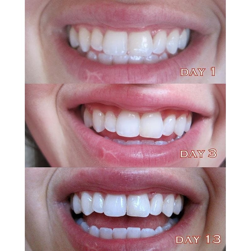 Miếng Dán Trắng Răng Crest Whitestrips Supreme - 1 miếng