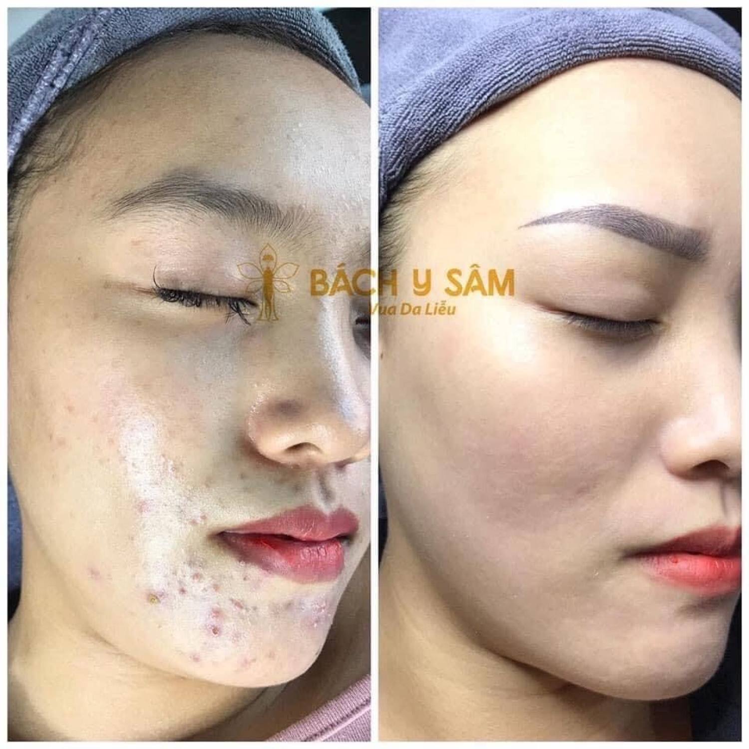 Bách Y Sâm 02 Plus 30ml Bạch Linh Chuyên Mụn