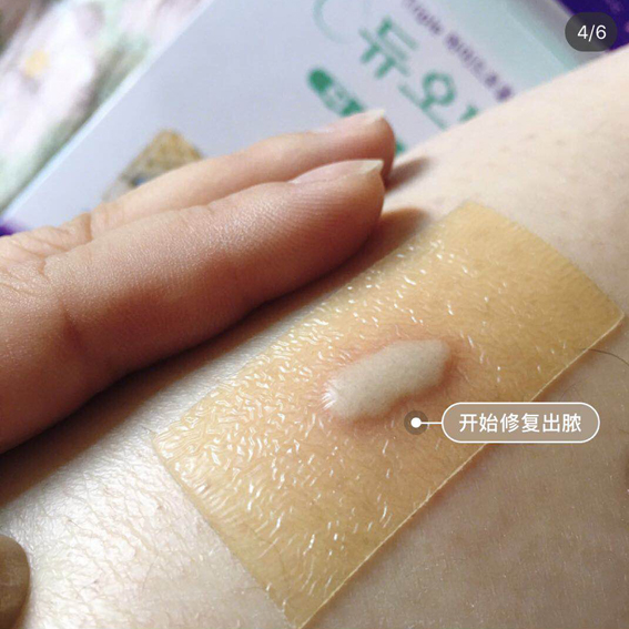 1 Miếng Dán Nhanh Xẹp Mụn DuoDerm Extra Thin