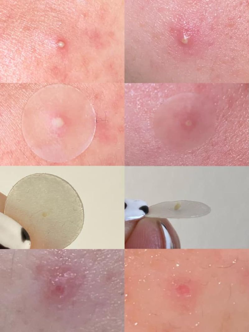 Miếng Dán Mụn Cosrx  Acne Pimple Patch 24 Miếng