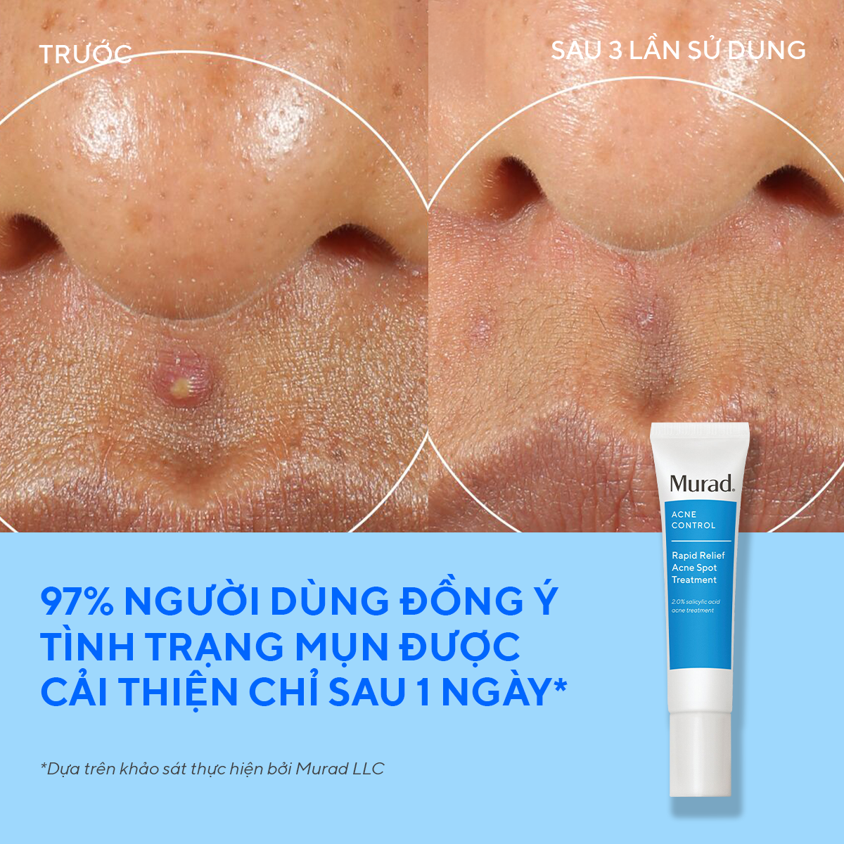[HSD 12 THÁNG] Gel chấm mụn Murad Rapid Relief Acne Treatment 15ml