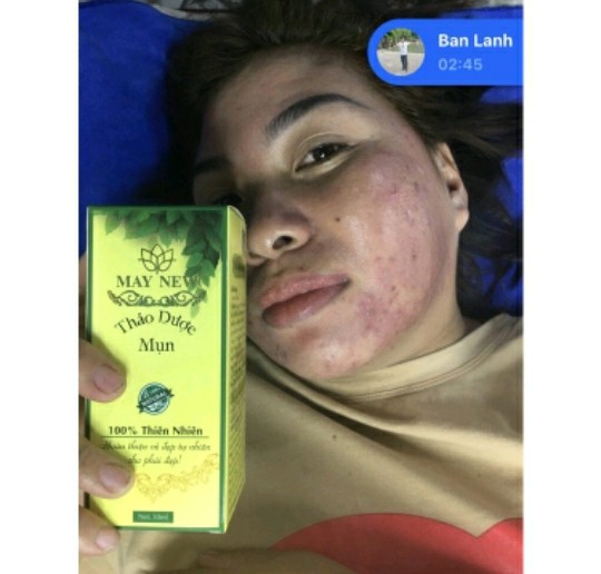 SERUM THẢO DƯỢC NHÂN SÂM SẠCH MỤN MAY NEW 50ML