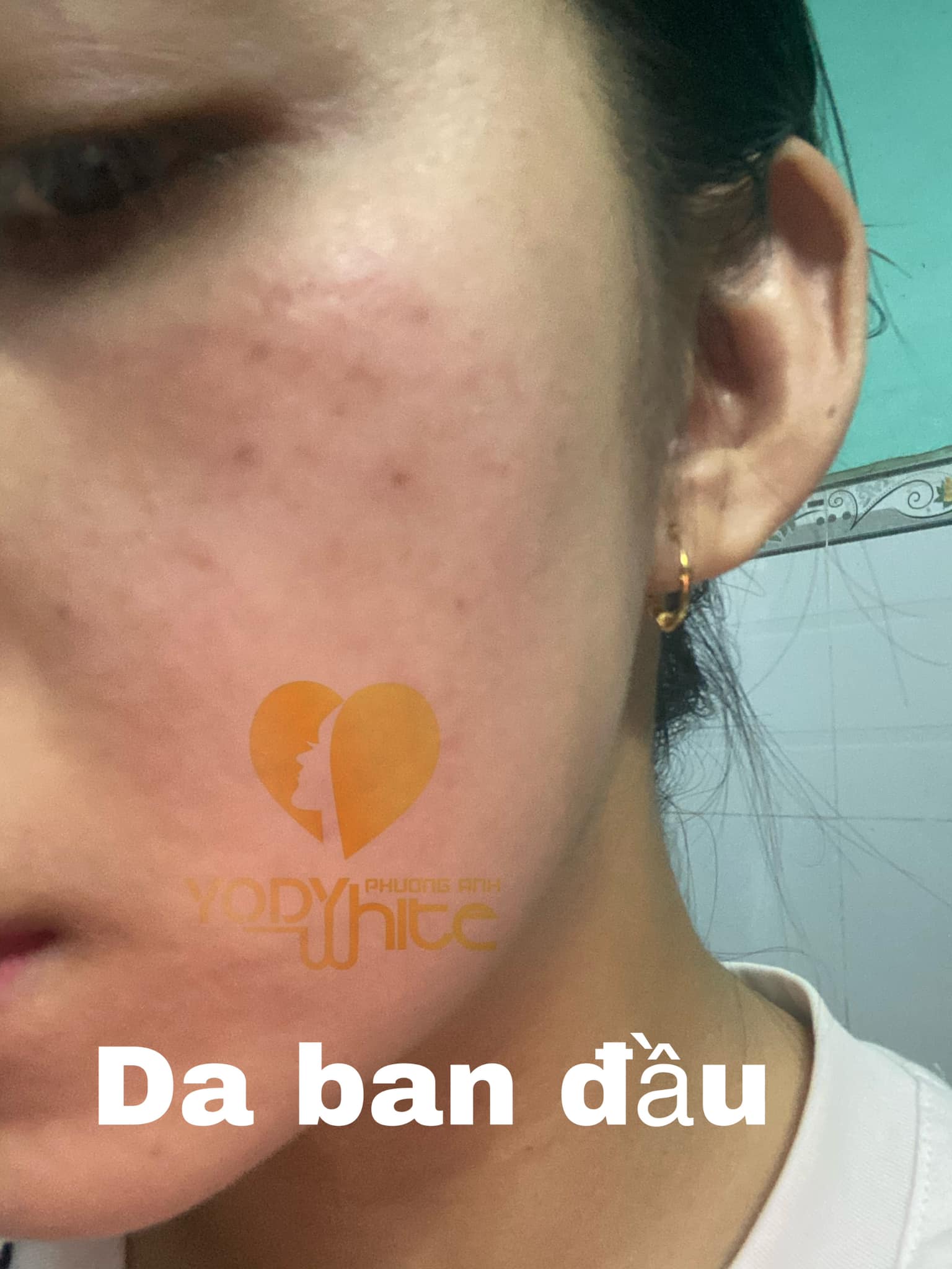 [TẶNG ẤM SIÊU TỐC +CHAI NƯỚC HOA PHÁP 20ML]-COMBO CHẤM TÀN NHANG,MỤN THỊT,MỤN RUỒI,MỤN CÓC 7 NGÀY BONG