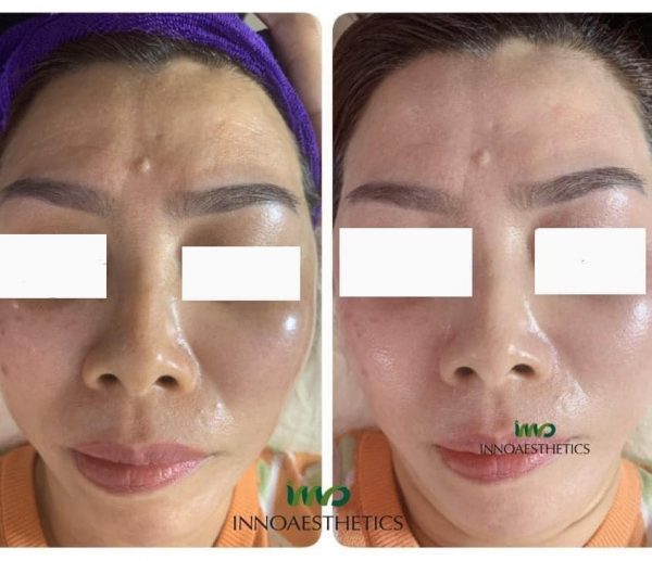 [ Chính hãng] Meso trắng da Restructurer Innoaesthetics Vitamin C