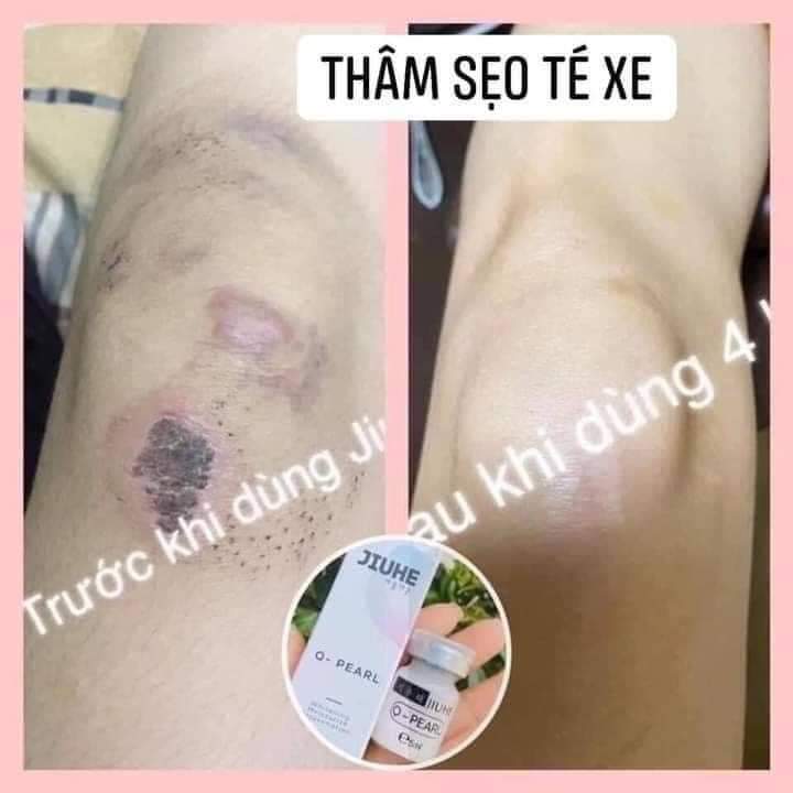 SERUM TRI THÂM JUHE HÀN QUỐC.
