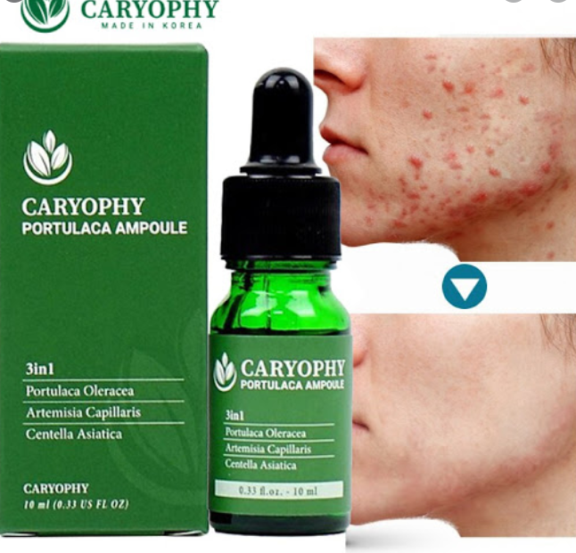 [HCM]Serum Ngừa Mụn Thâm Dành Cho Da Nhờn Caryophy [HÀNG CHÍNH HÃNG]