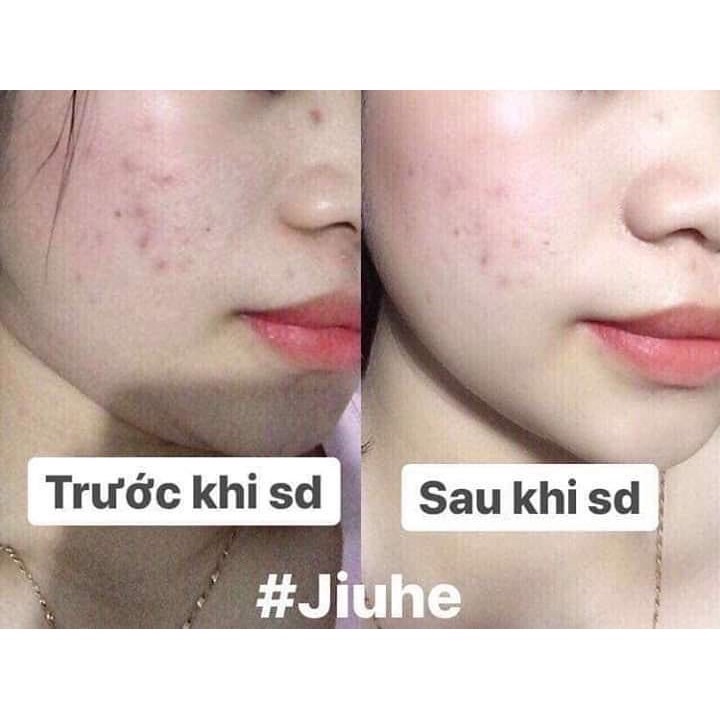 serum jiuhe giảm thâm