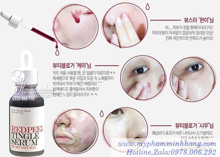 Tinh Chất Thay Da Sinh Học So’Natural Red Peel Tingle Serum
