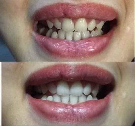 Bột trắng răng thảo mộc 37
