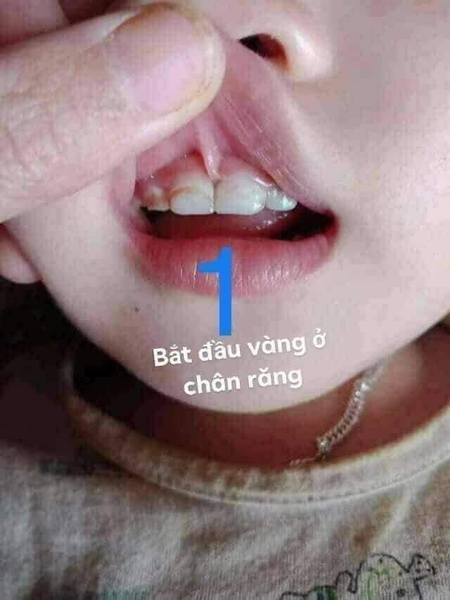 Sâu sún răng không còn là nỗi lo của mẹ