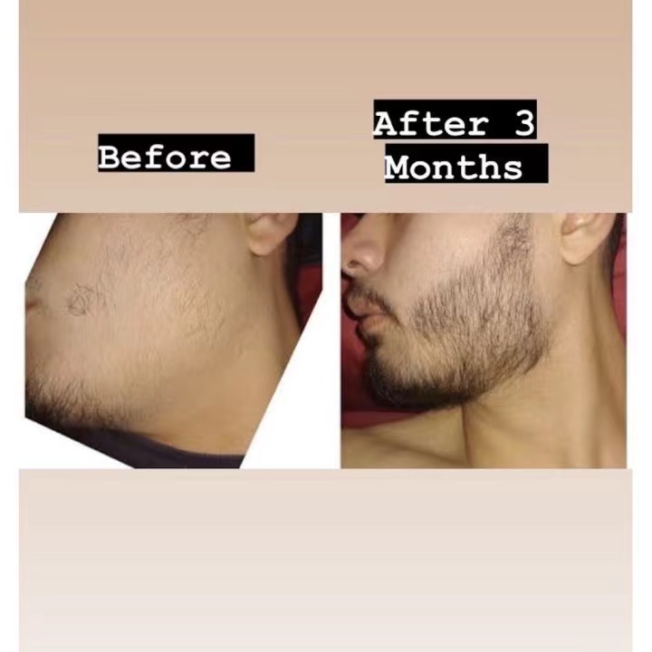 Minoxidil 15% (Bán chạy nhất) (Niêm phong) Sản xuất tại Thái Lan đích thực
