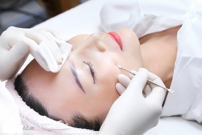 Bộ 4 cây lấy mụn rất an toàn 8 đầu