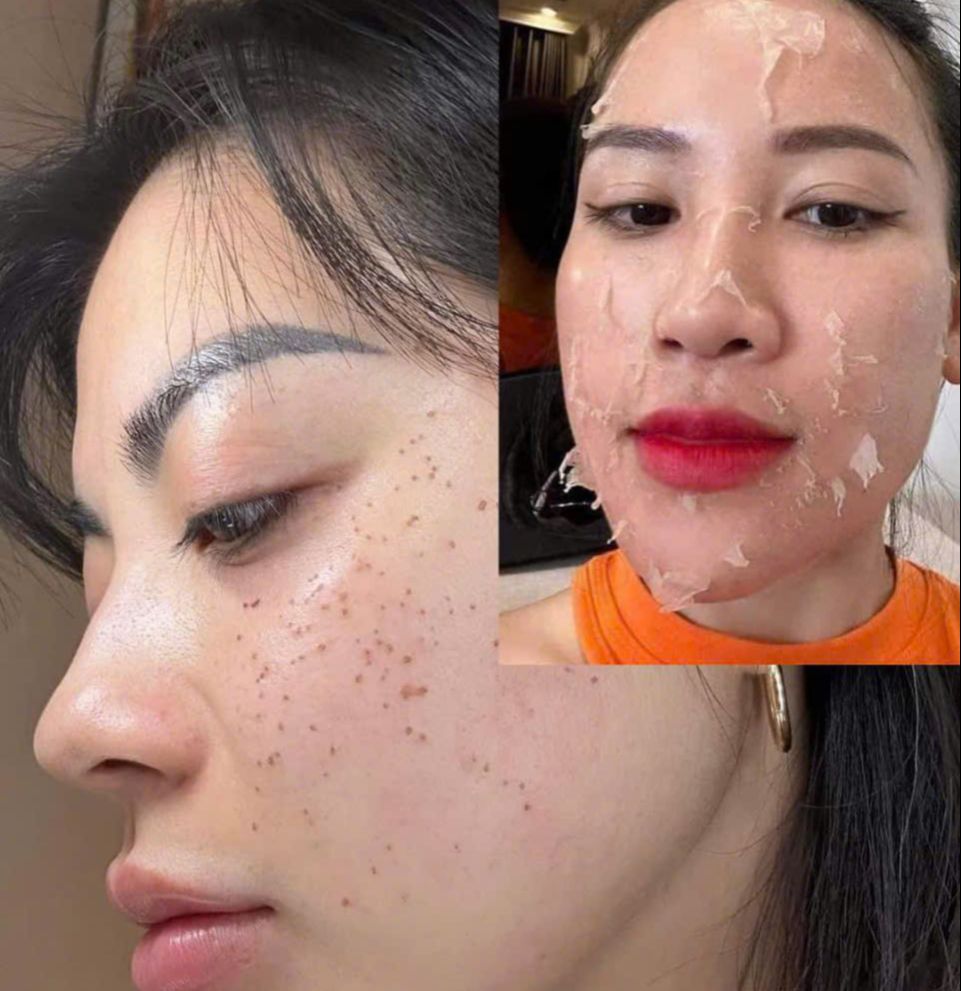 Srum Tái Tạo Yody Phương Anh làm đẹp da mụn nám tàn nhang da không đều màu